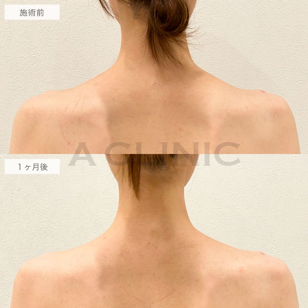 ボトックス注射の症例写真
