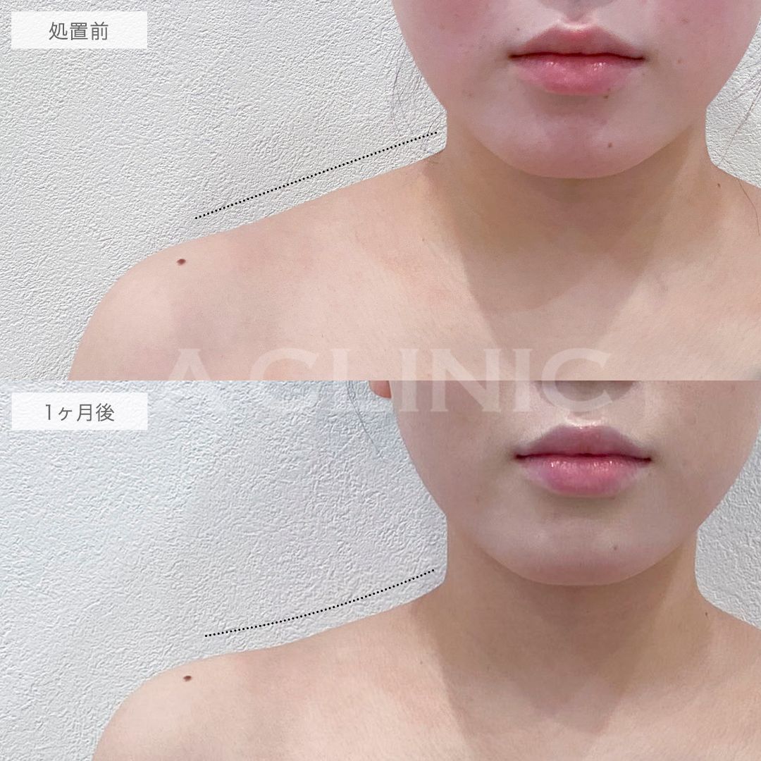 ボトックス注射の症例写真