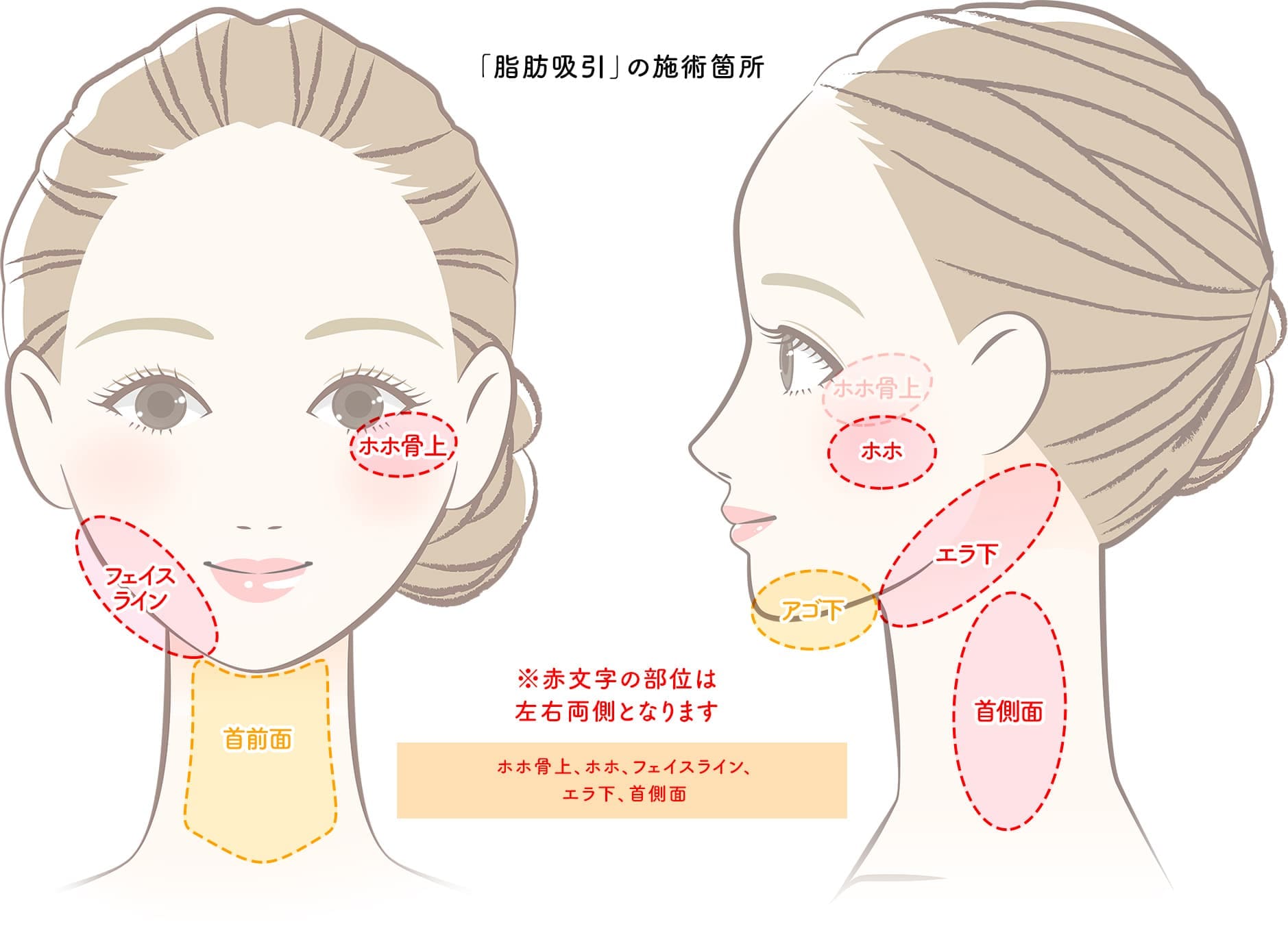 顔の脂肪吸引