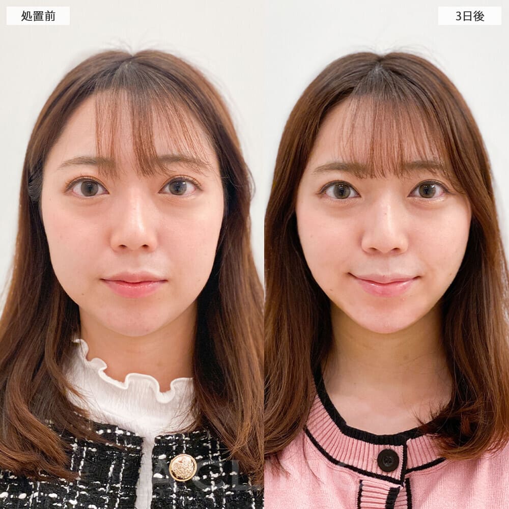 顔の脂肪吸引の症例写真