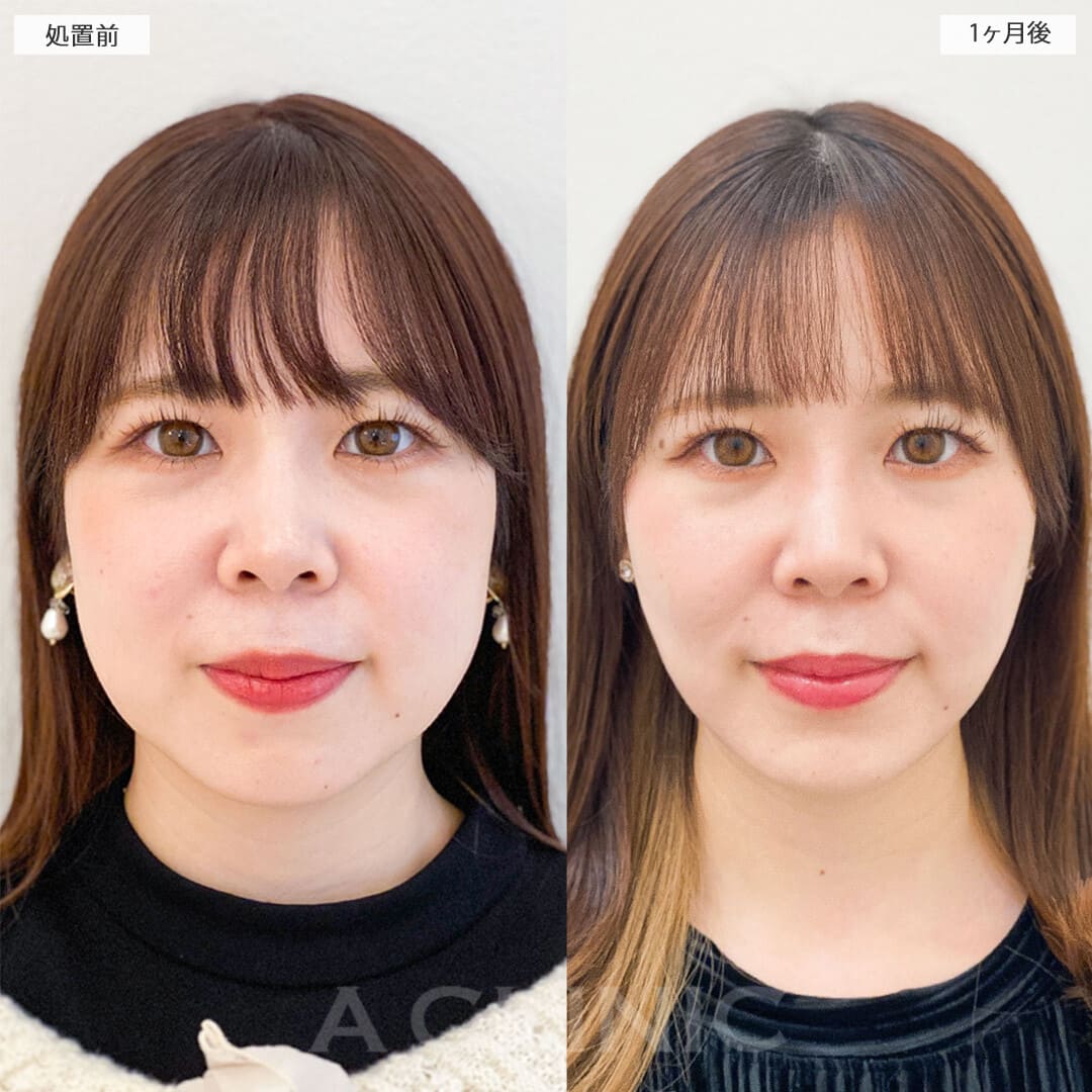 顔の脂肪吸引の症例写真