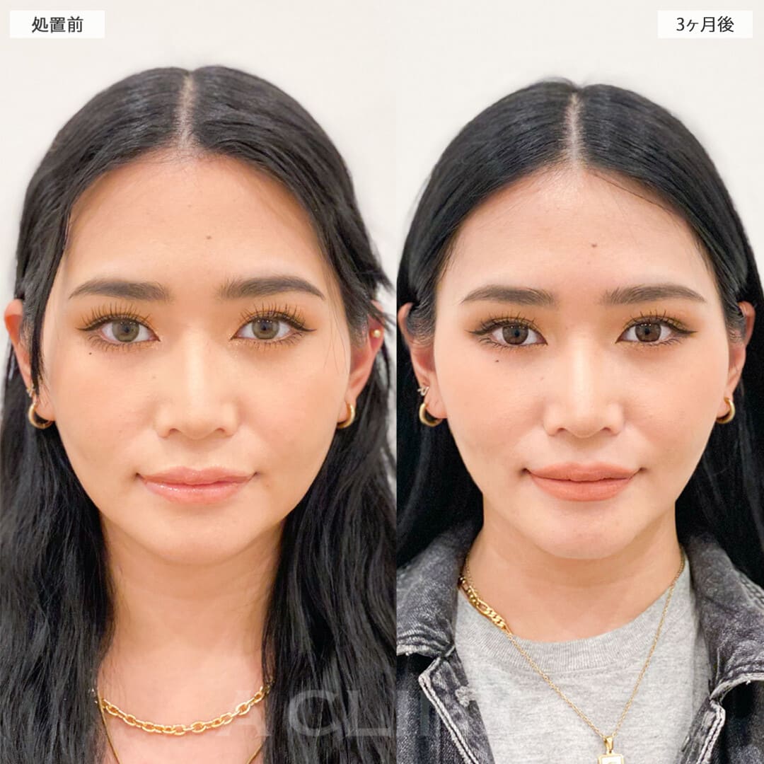 顔の脂肪吸引の症例写真