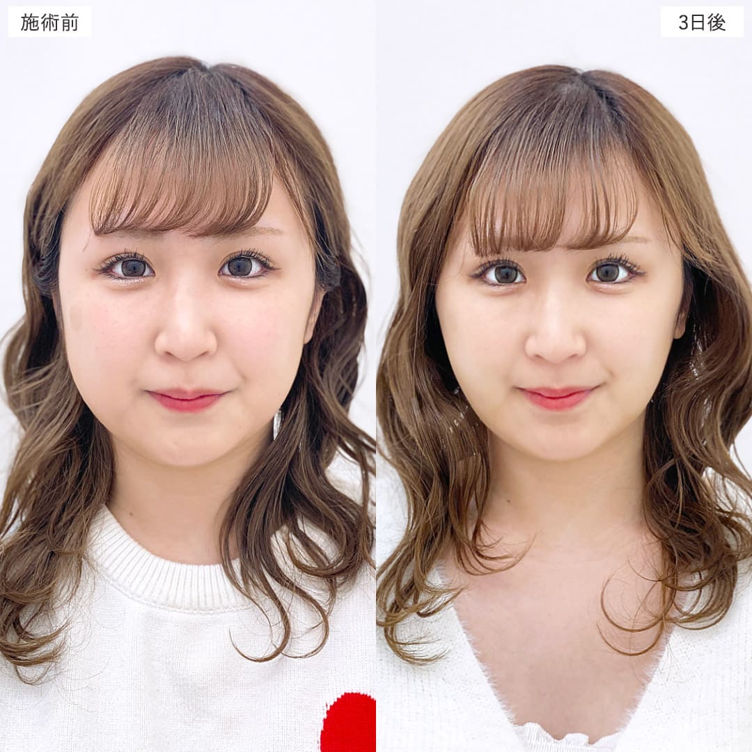 顔の脂肪吸引の症例写真