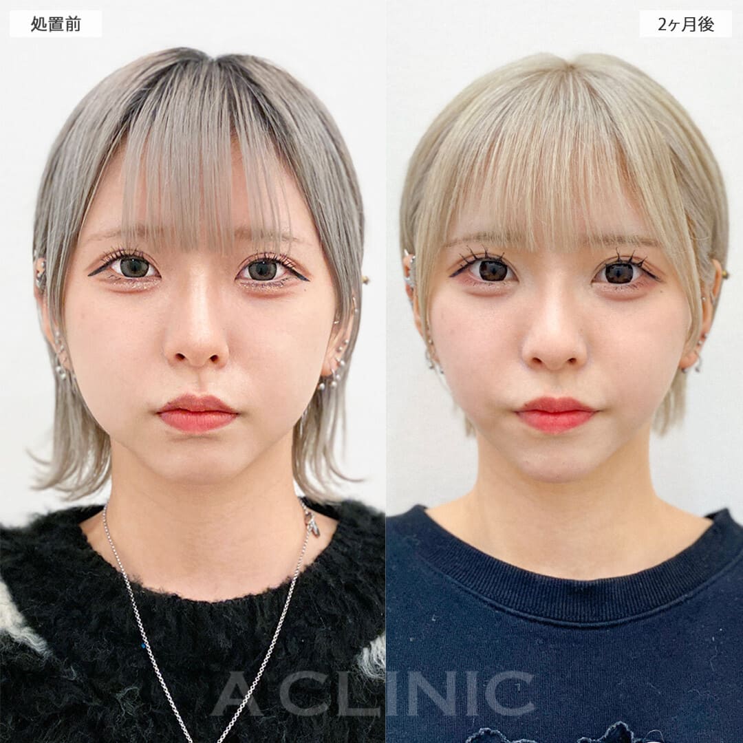 顔の脂肪吸引の症例写真
