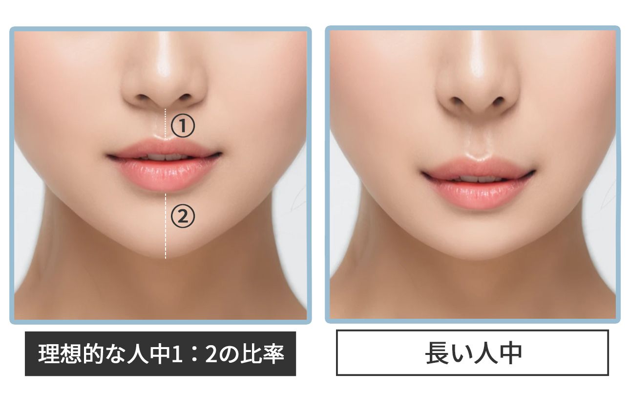 切らない人中短縮(Cカール形成術)