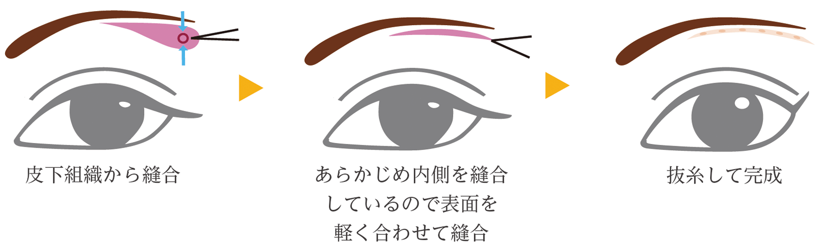 眉下リフト ベーシック