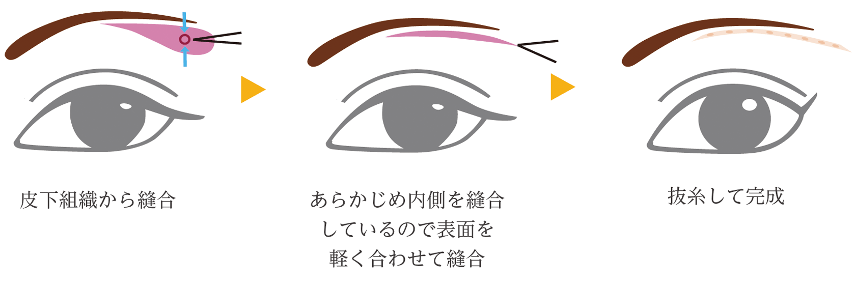 眉下リフト ロング
