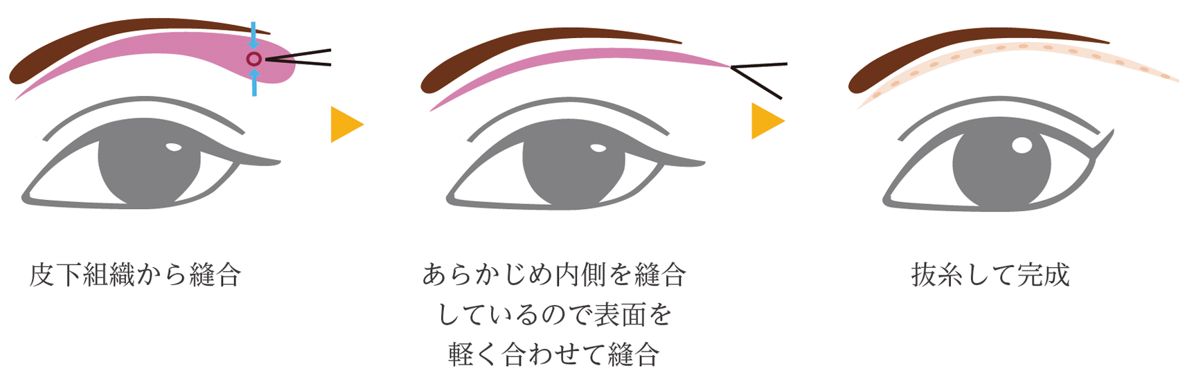 眉下リフト エクストラロング