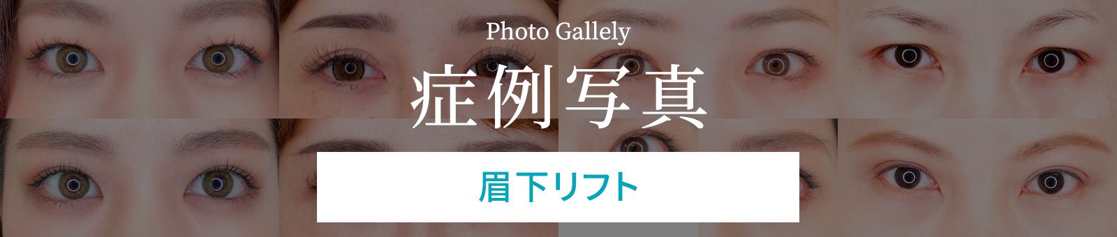 症例写真 眉下リフト