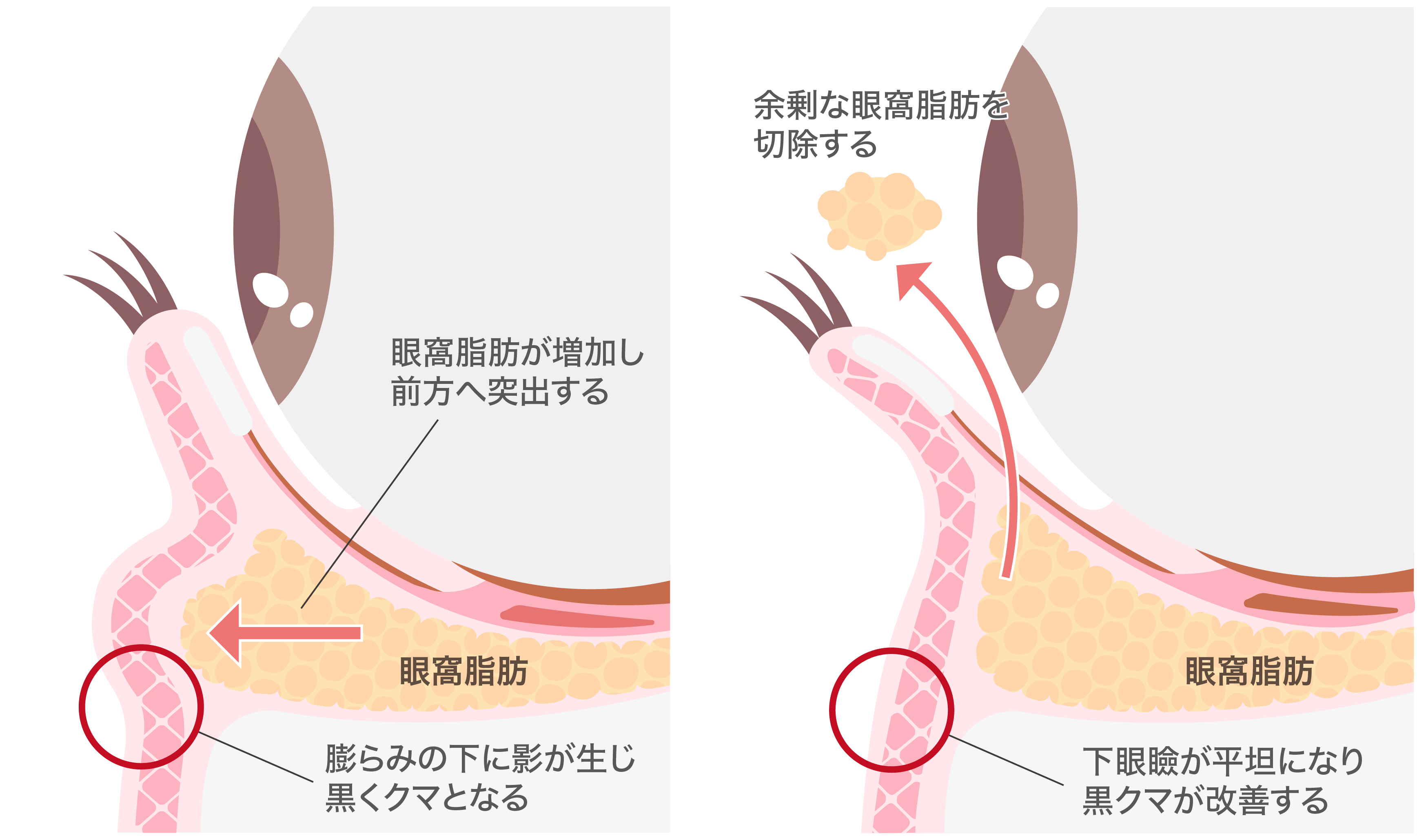 目の下のふくらみ取り
