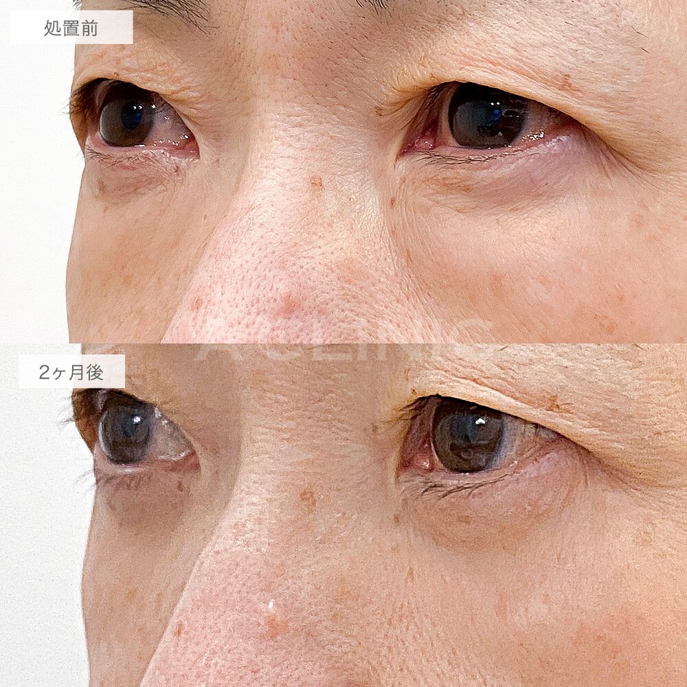 目の下のふくらみ取りの症例写真