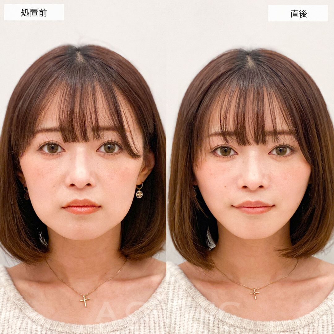 Aスレッド症例