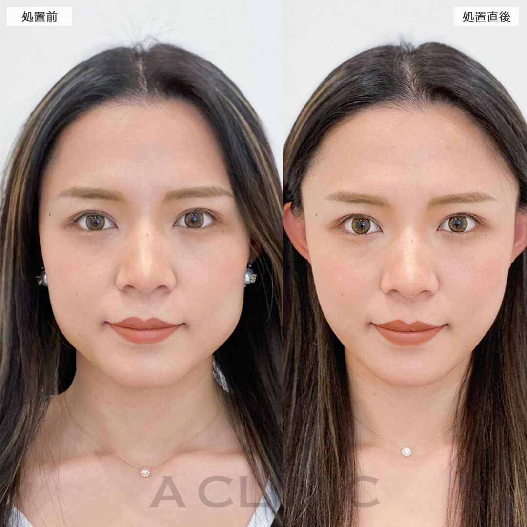 Aスレッド症例