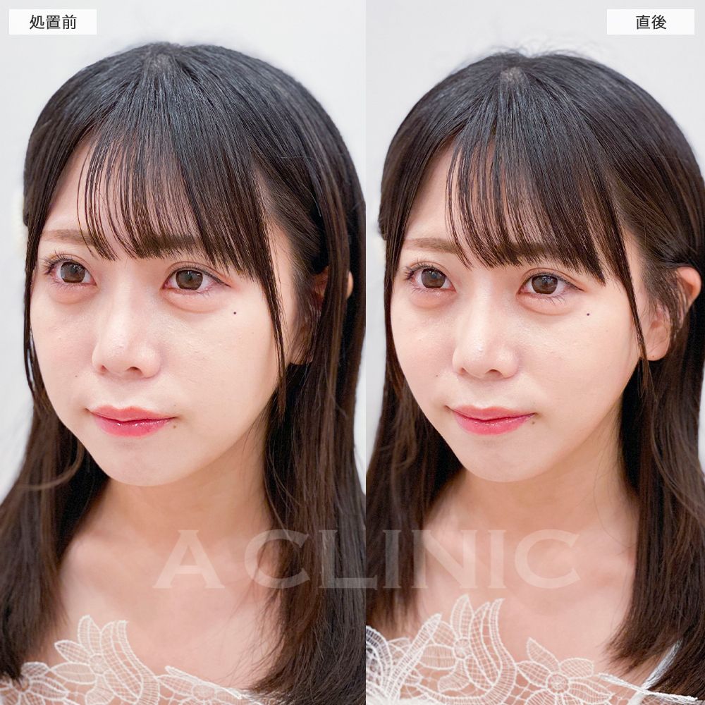 Aスレッド症例