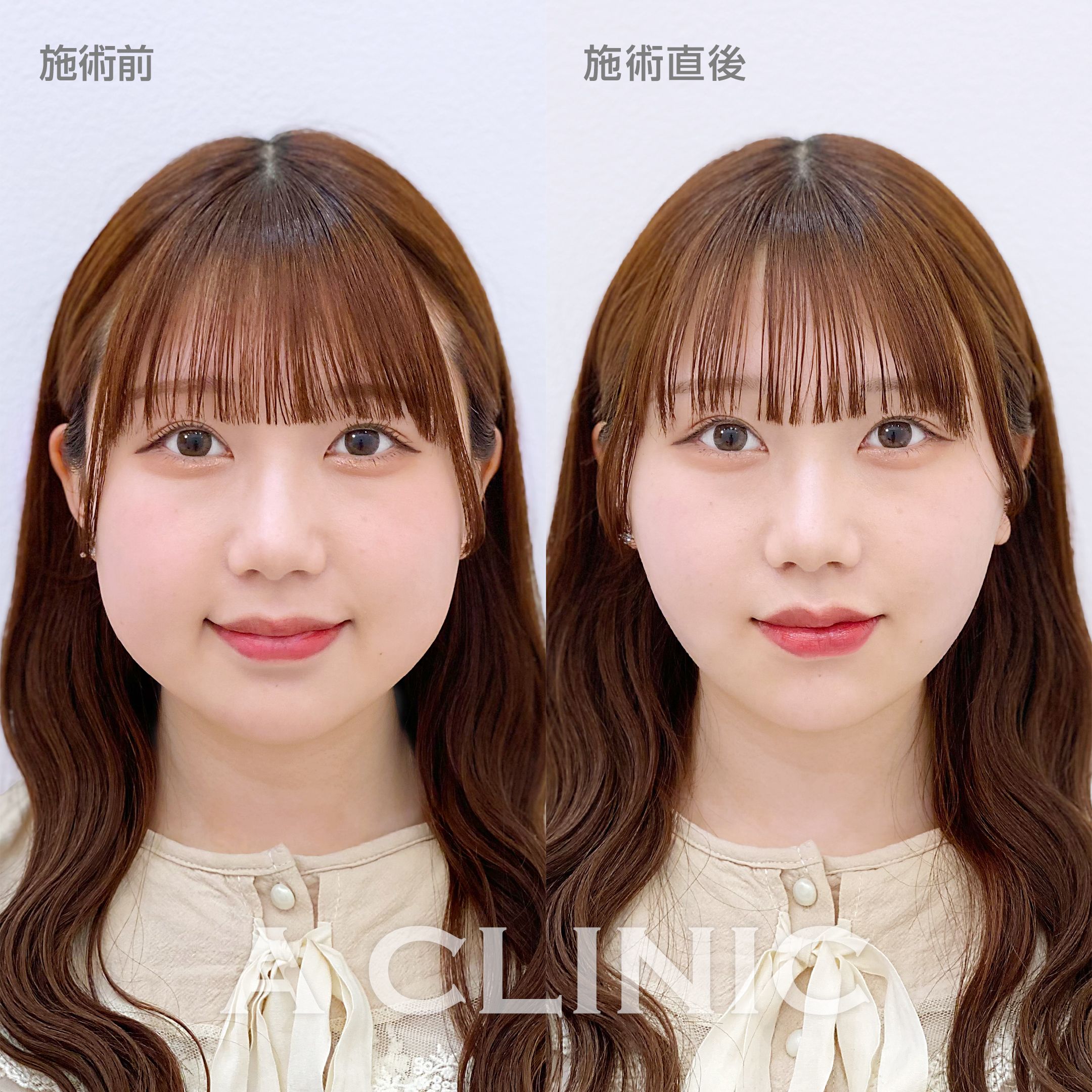 1day小顔脂肪吸引モニター