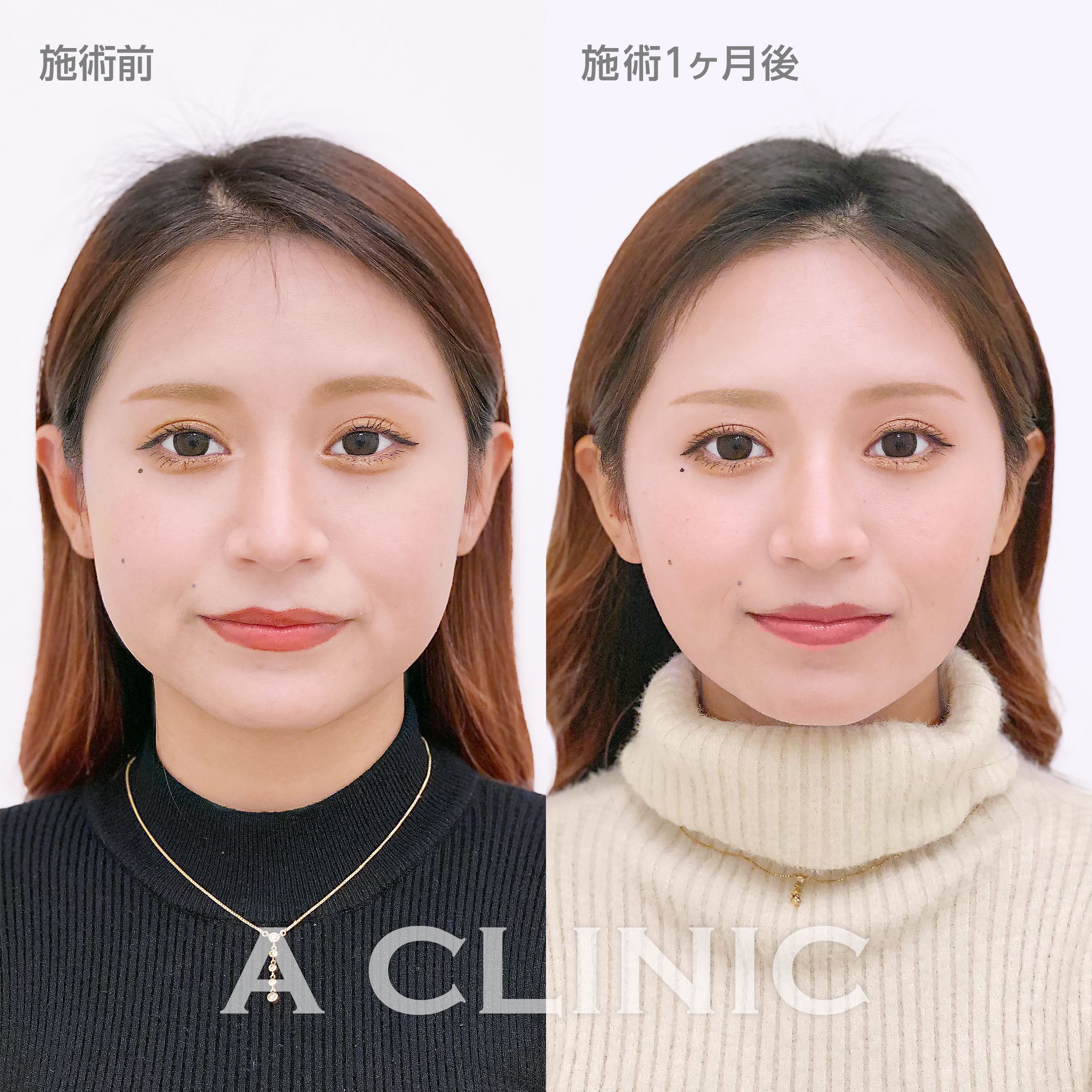 1day小顔脂肪吸引モニター