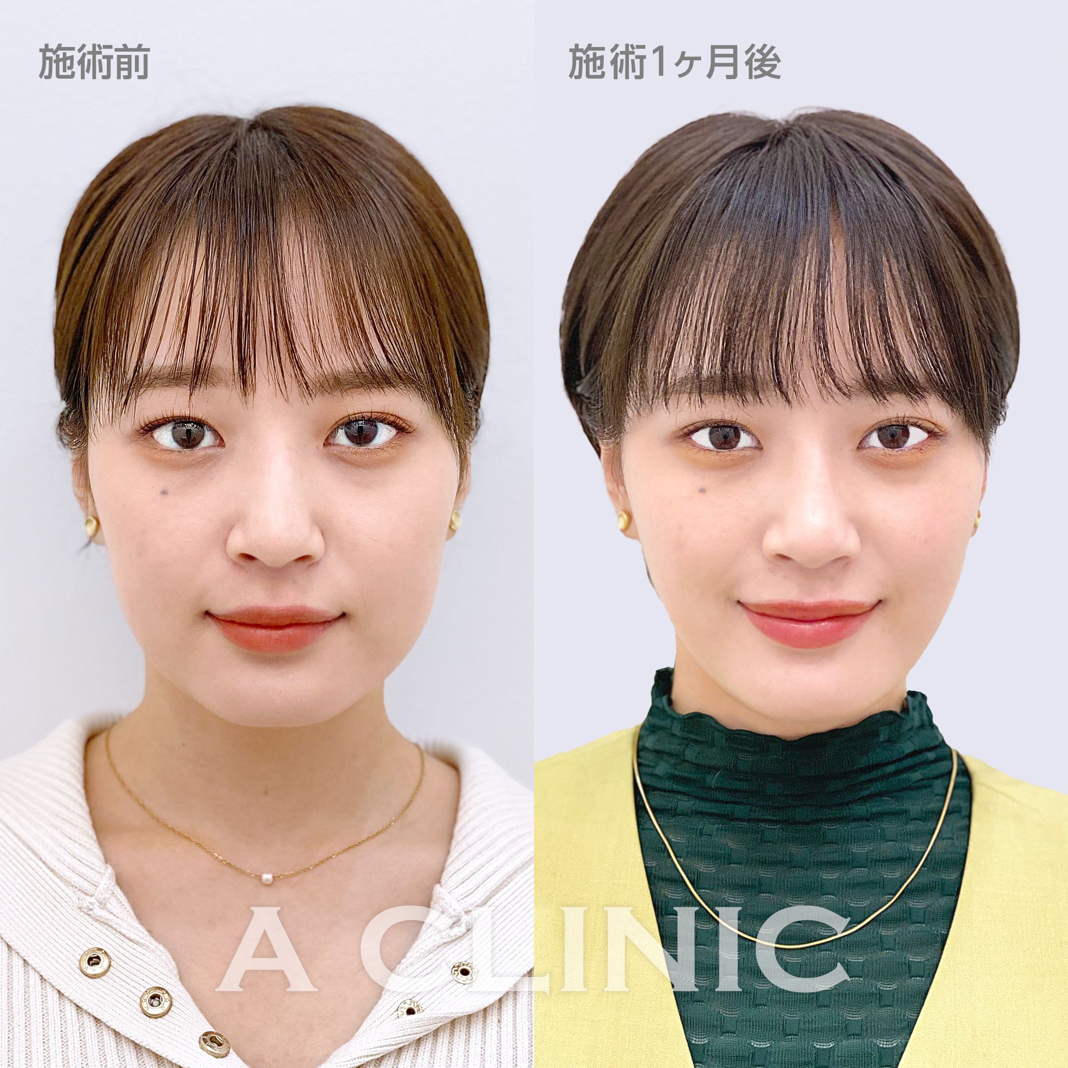 1day小顔脂肪吸引モニター