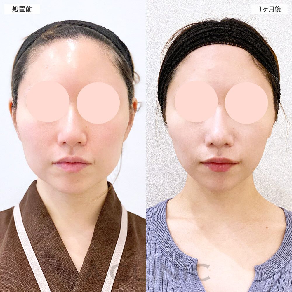 1day小顔脂肪吸引モニター