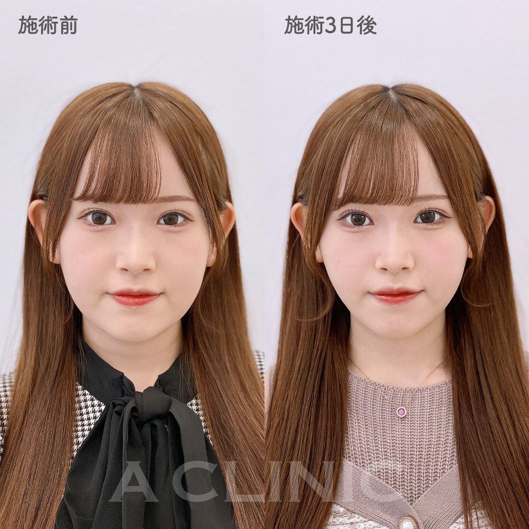 1day小顔脂肪吸引モニター