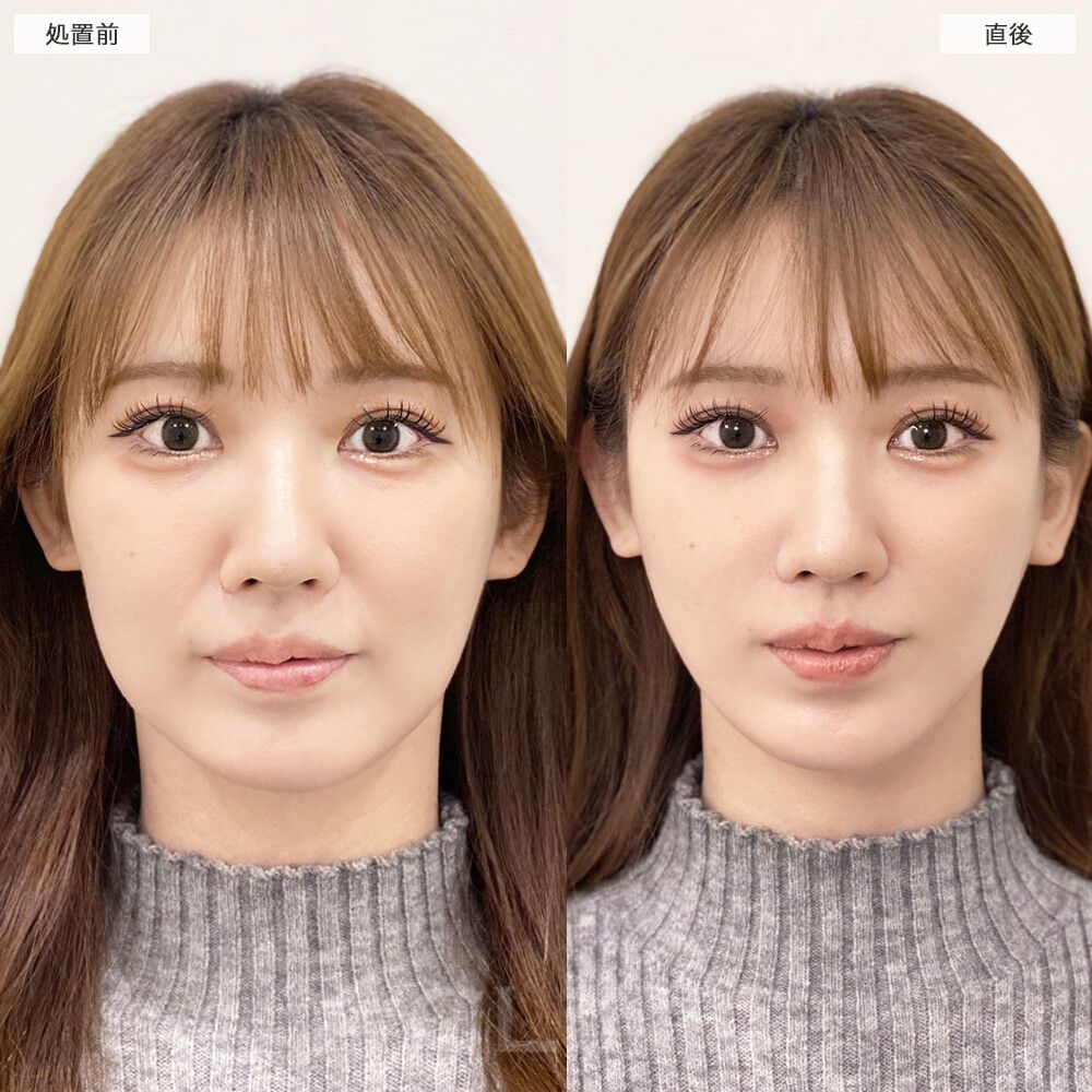 Aスレッド症例写真