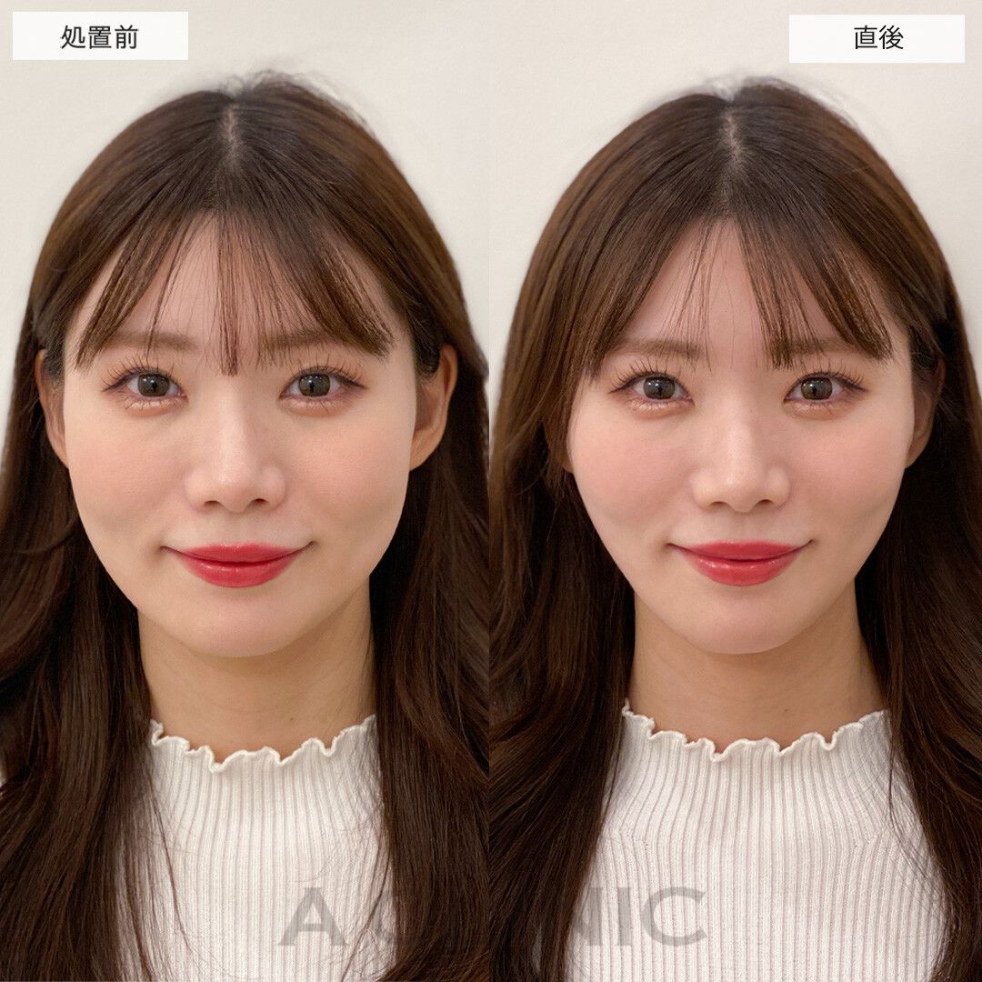 Aスレッド症例写真