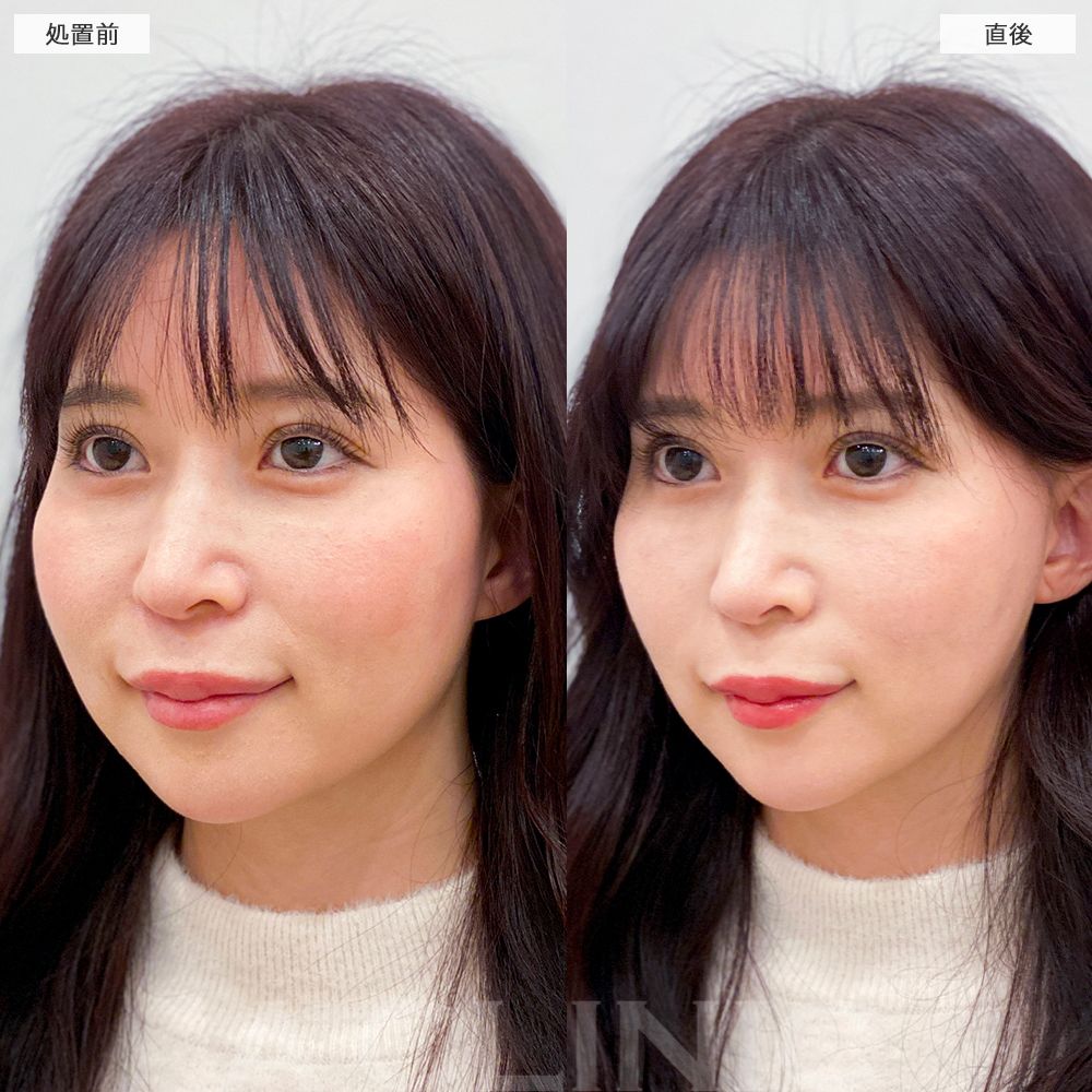 Aスレッド症例写真