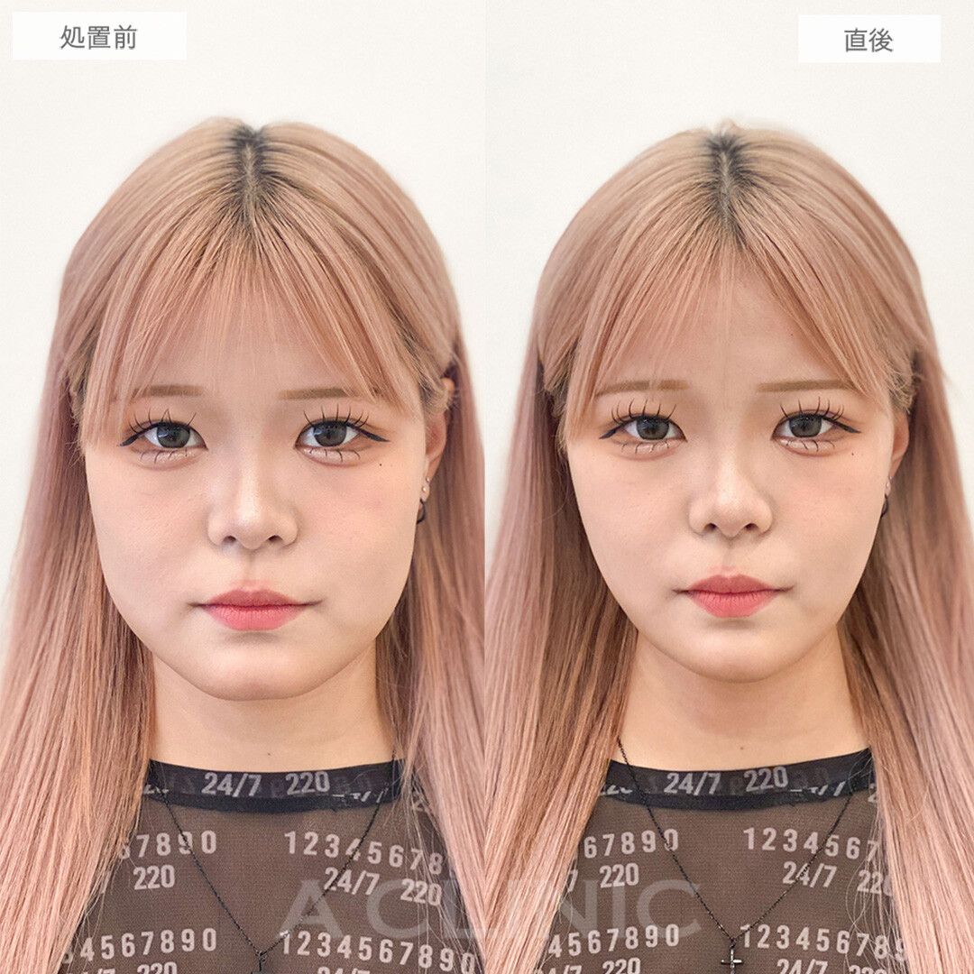 Aスレッド症例写真