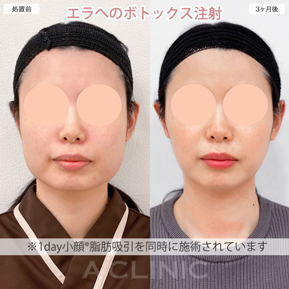 ボトックス注射症例写真