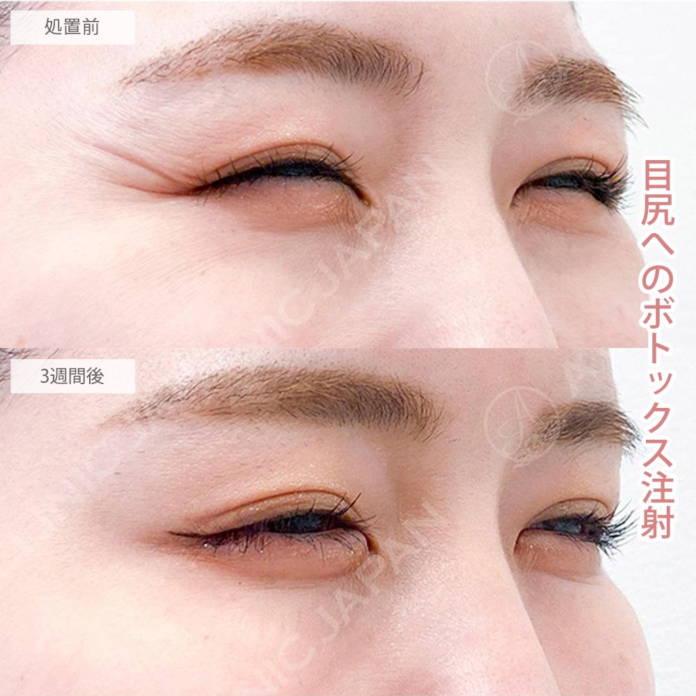 ボトックス注射症例写真