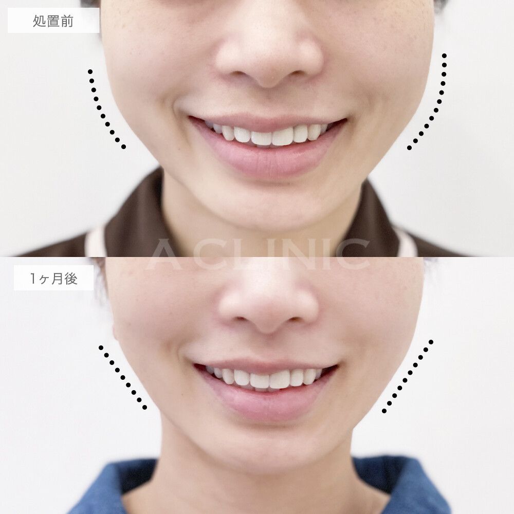 バッカルファット除去術症例写真