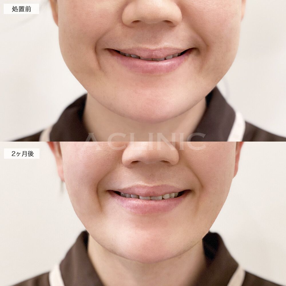 バッカルファット除去術症例写真
