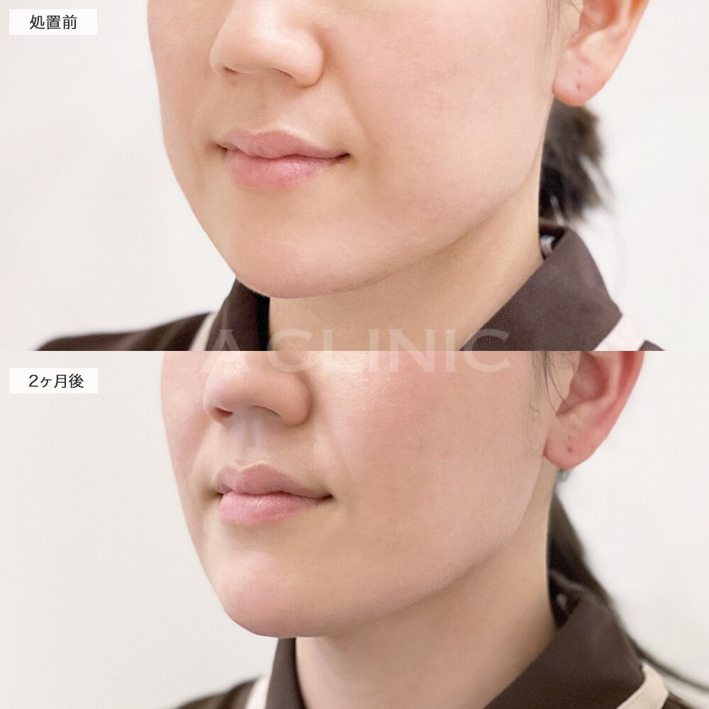 バッカルファット除去術症例写真