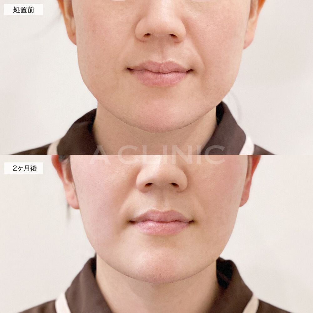 バッカルファット除去術症例写真