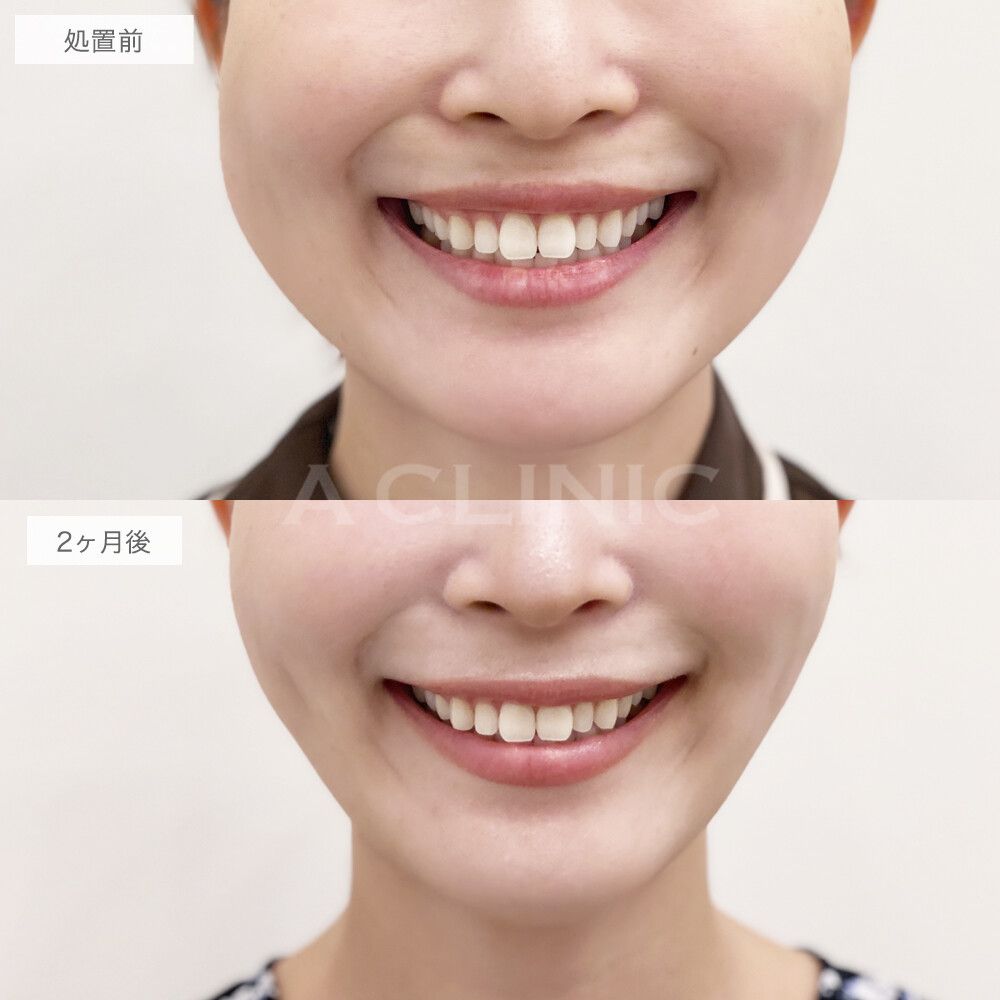 バッカルファット除去術症例写真