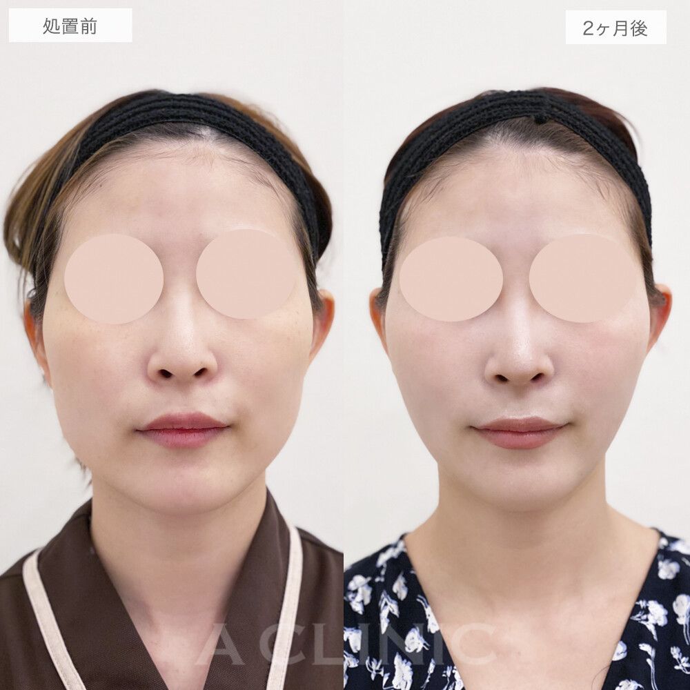 バッカルファット除去術症例写真