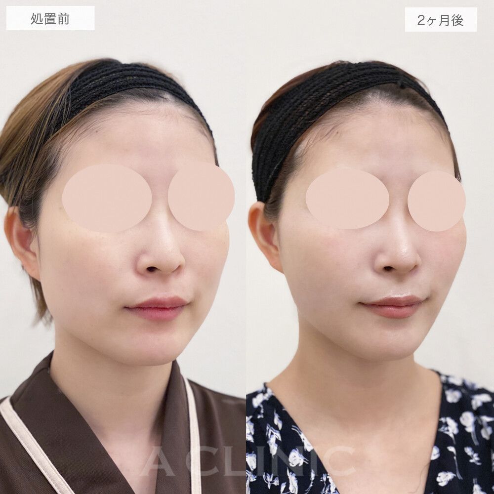 バッカルファット除去術症例写真
