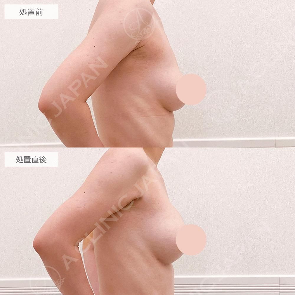 ドリームバスト症例写真