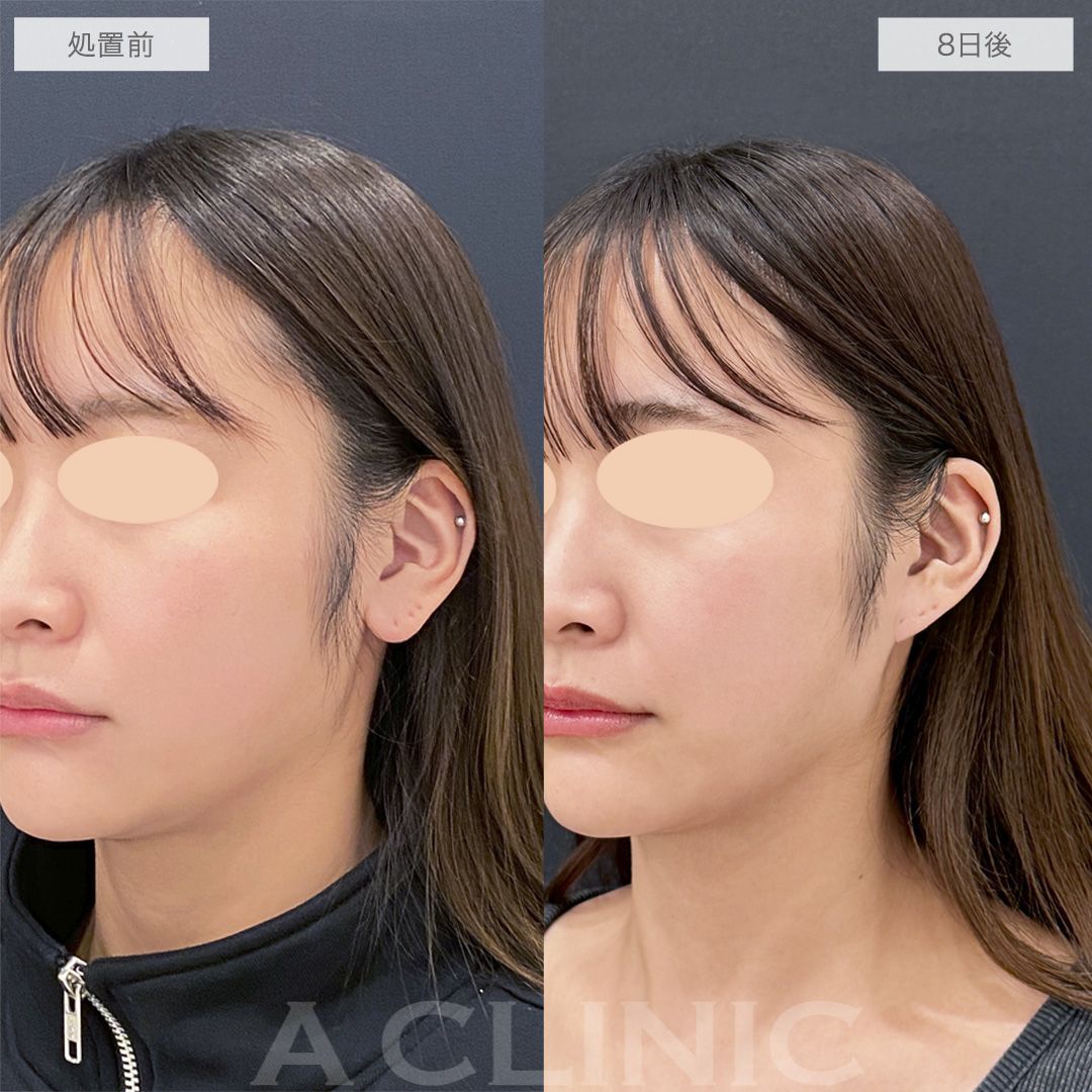 耳たぶ縮小術症例写真