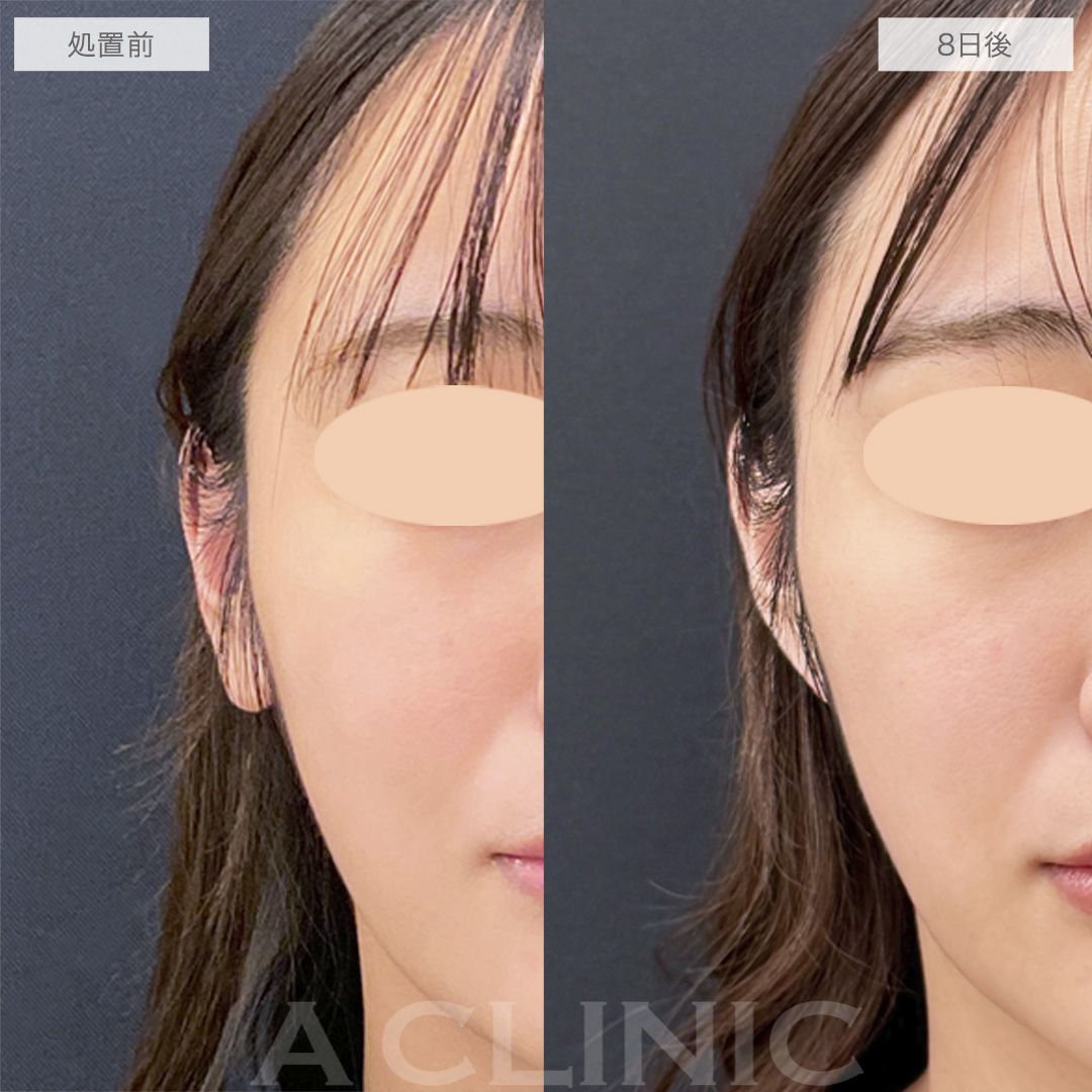 耳たぶ縮小術症例写真