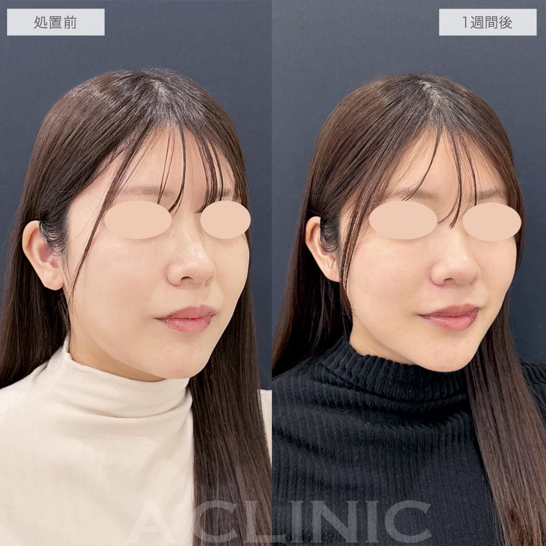 耳たぶ縮小術症例写真