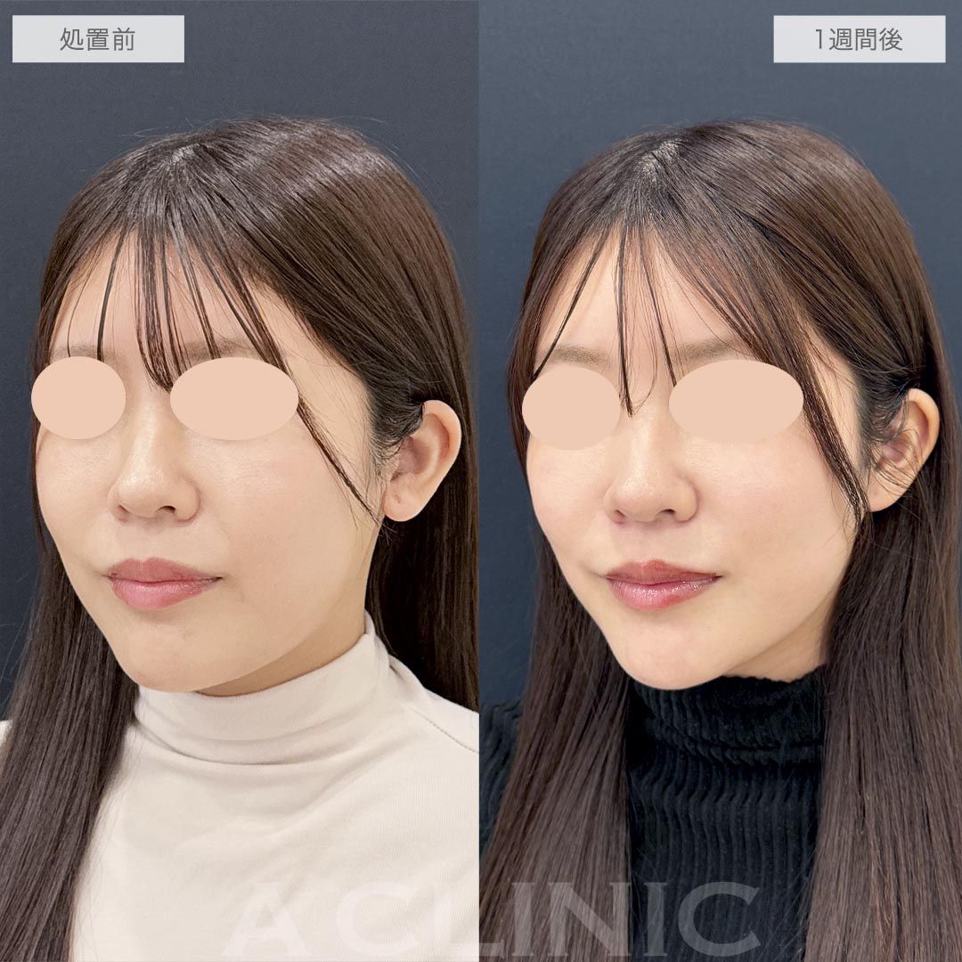耳たぶ縮小術症例写真