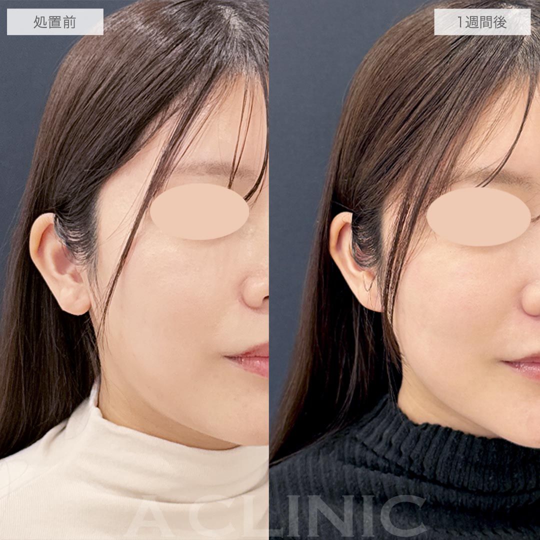 耳たぶ縮小術症例写真