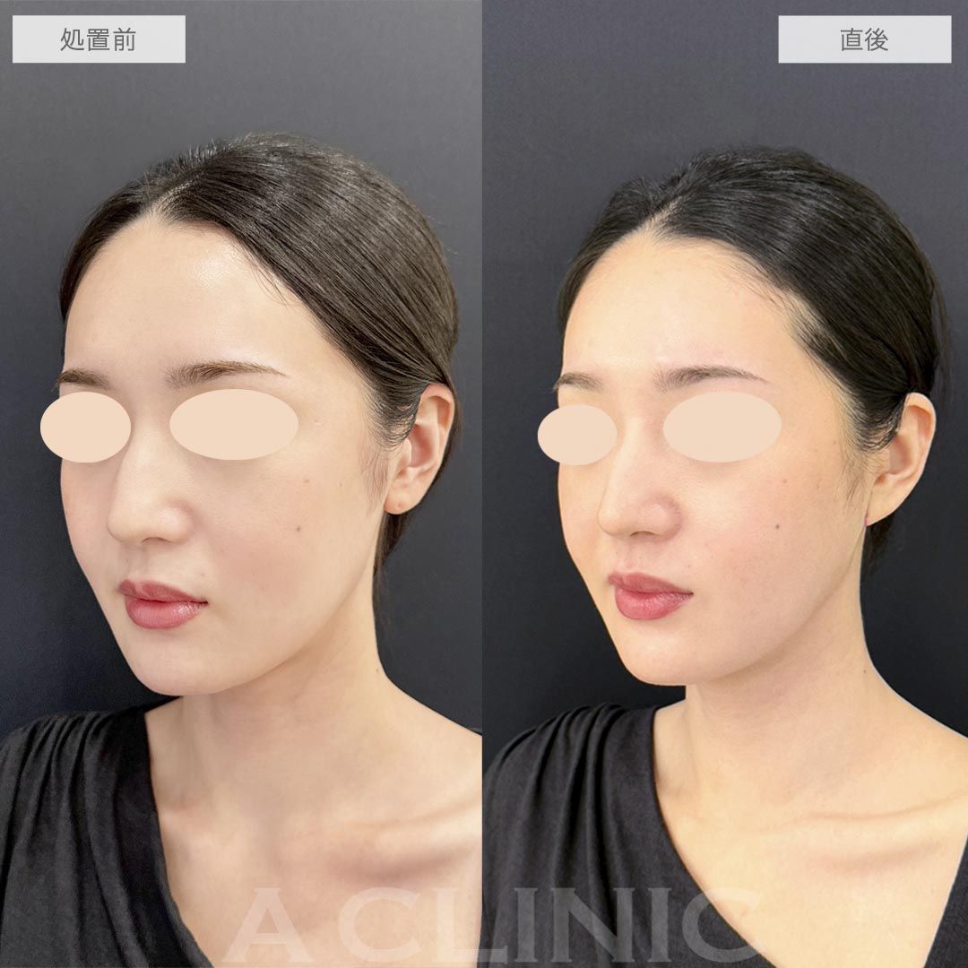 耳たぶ縮小術症例写真