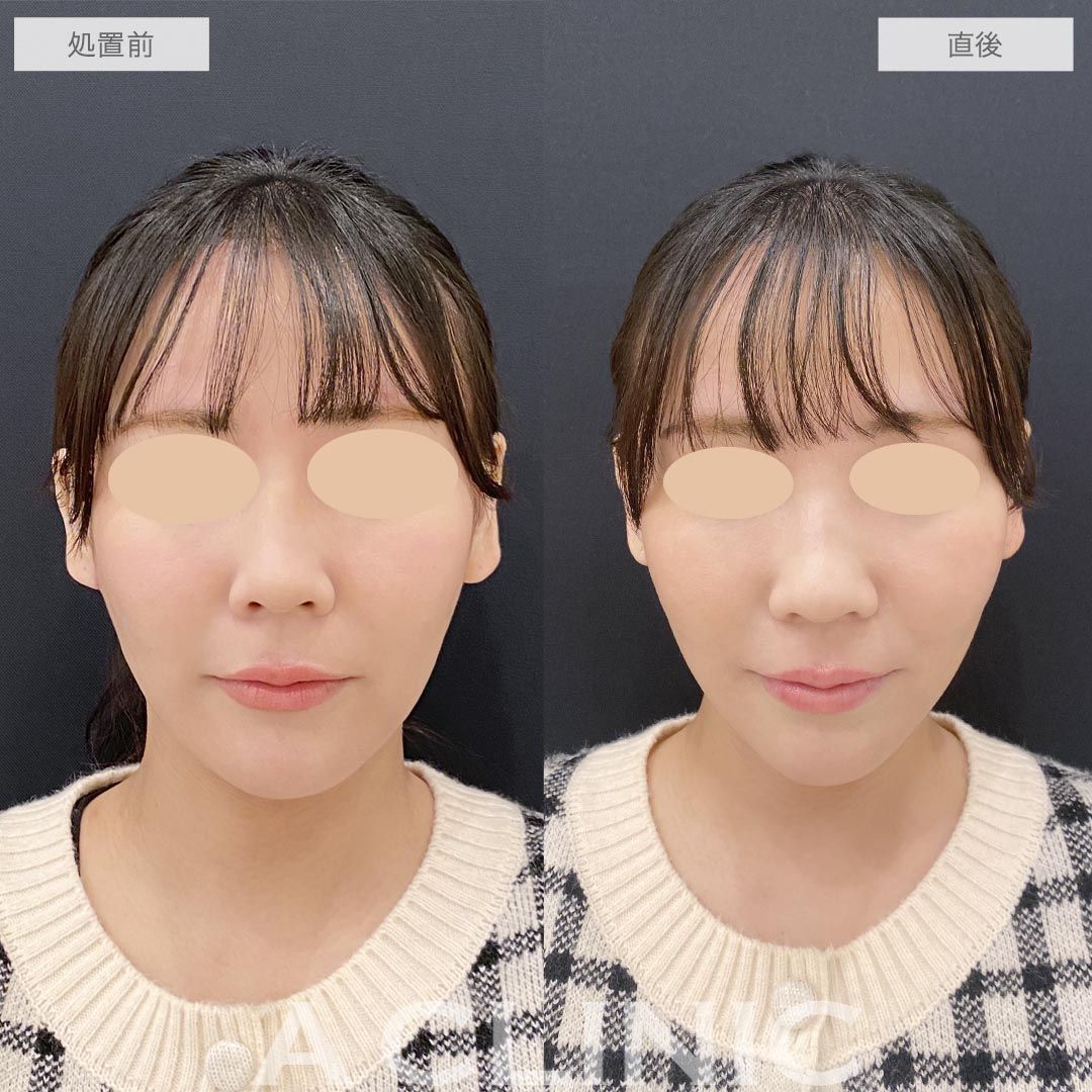 耳たぶ縮小術症例写真