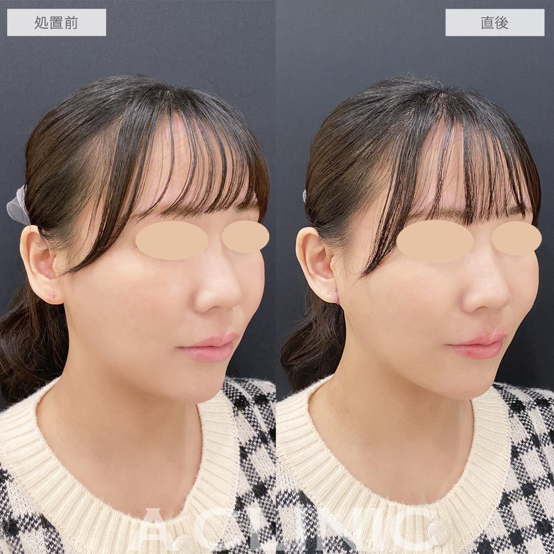 耳たぶ縮小術症例写真