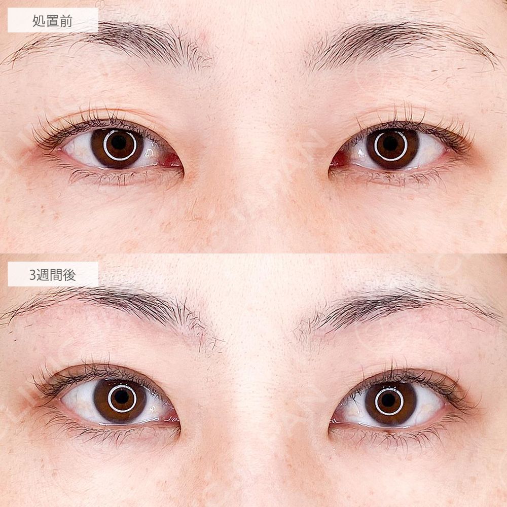 目と眉短縮術症例写真