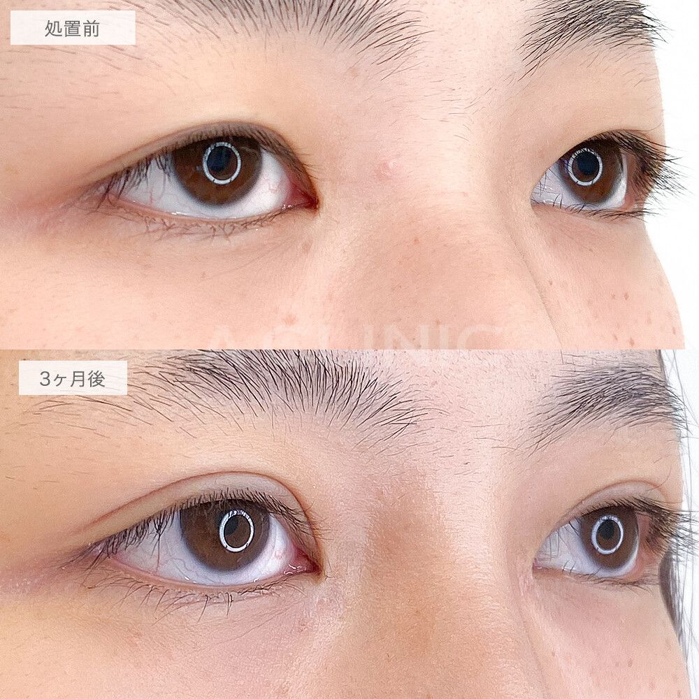 二重術切開法