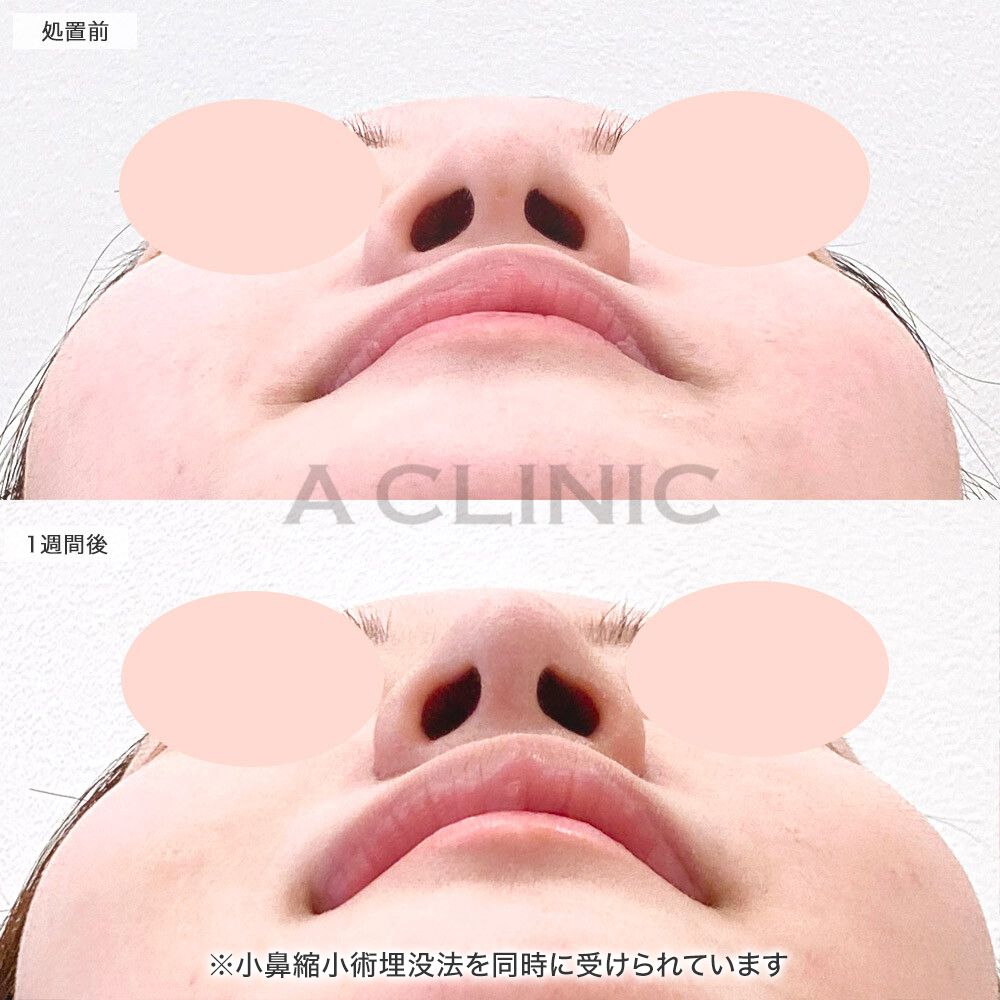 鼻先縮小術埋没法症例写真