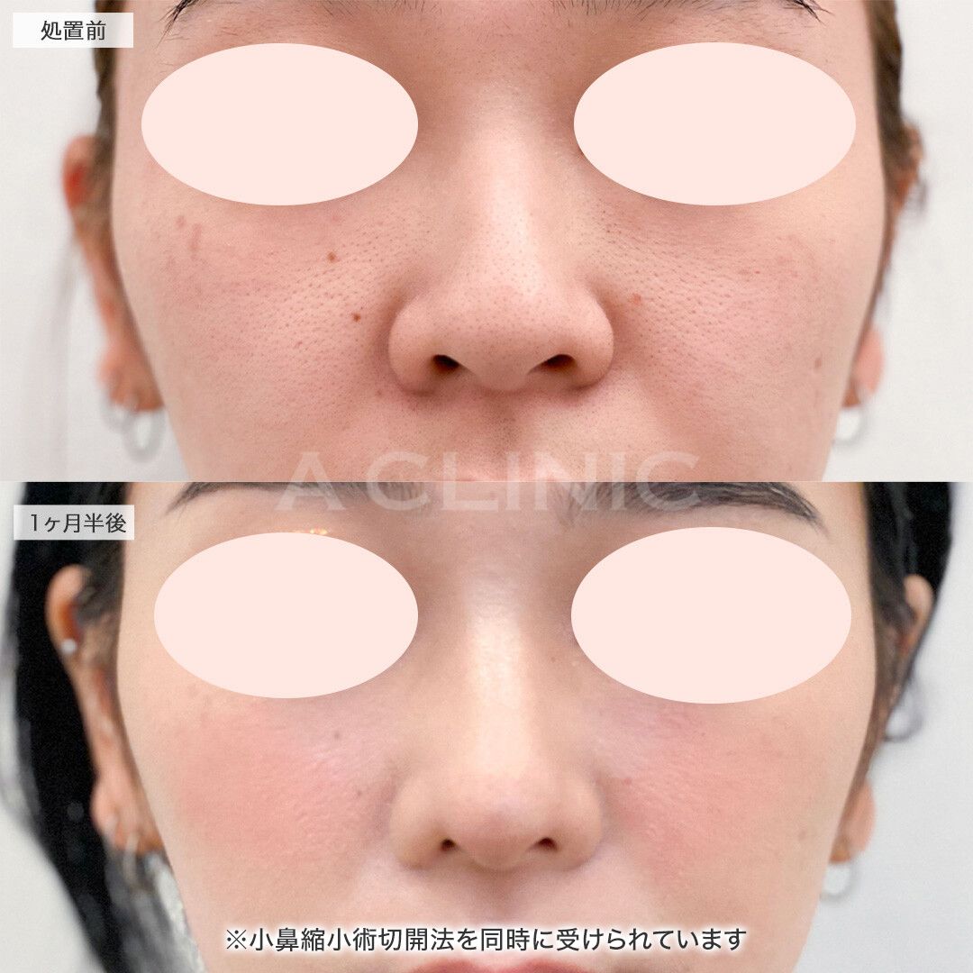 鼻先縮小術埋没法症例写真
