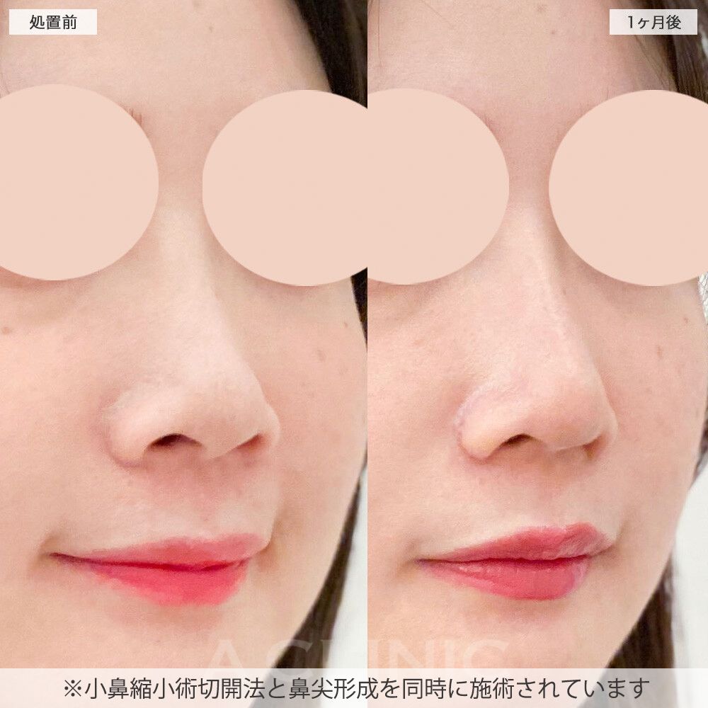 鼻先縮小術切開法症例写真